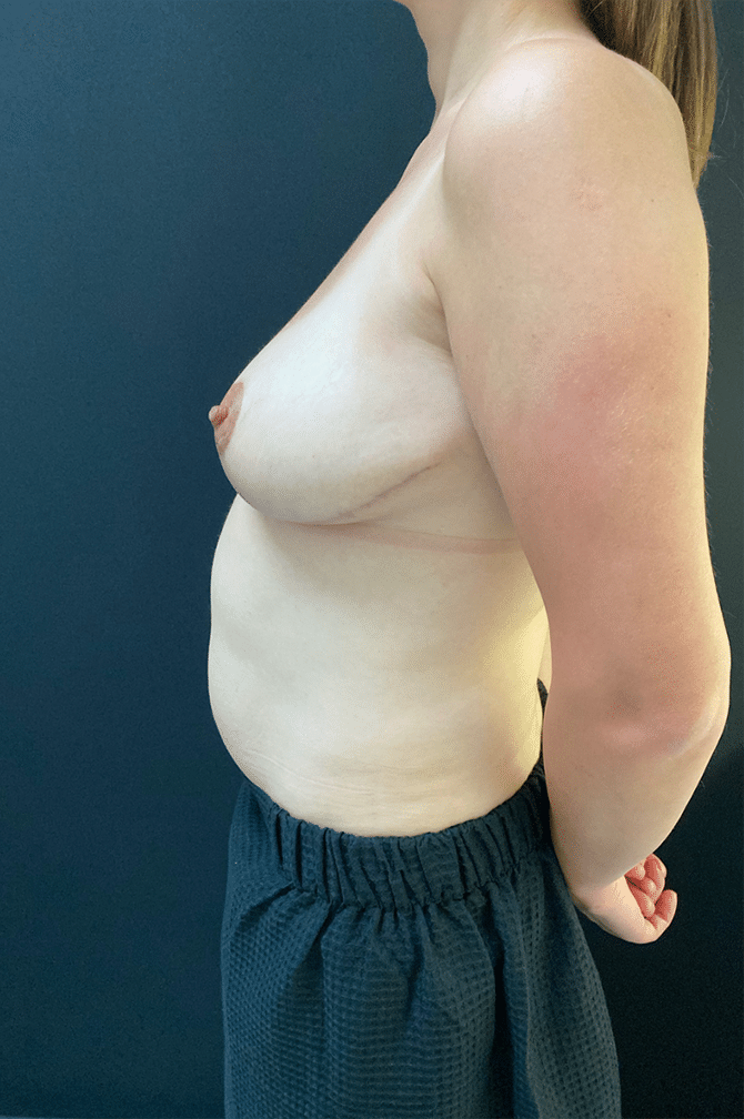 After Image: Breast Reduction - left-side