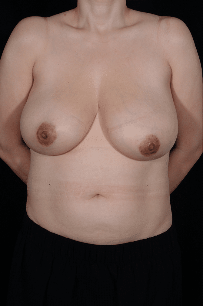 Before Image: Breast Reduction - front