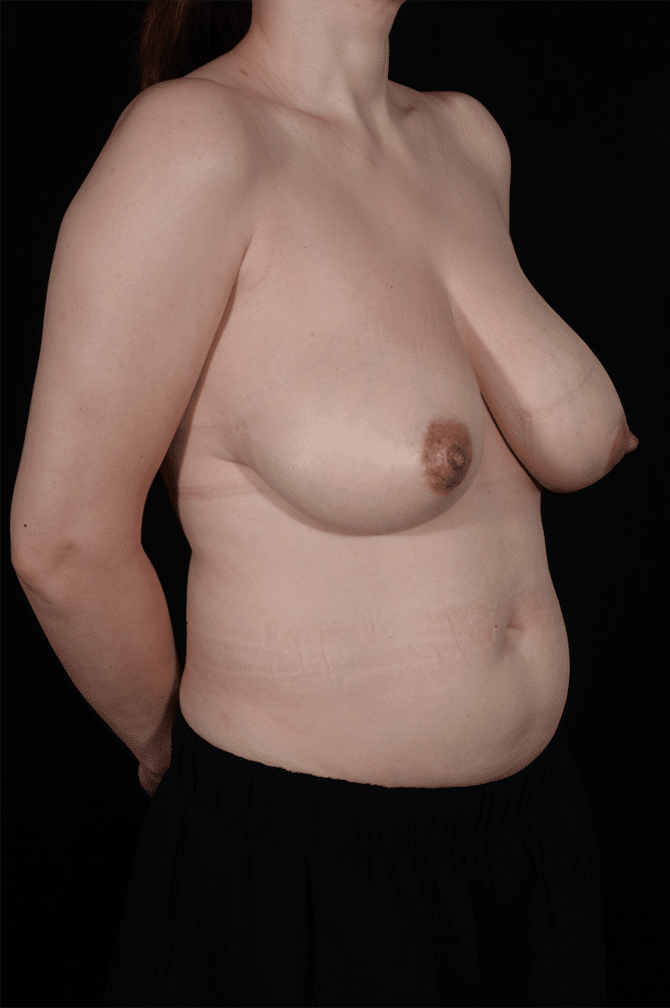 Before Image: Breast Reduction - right-front-oblique