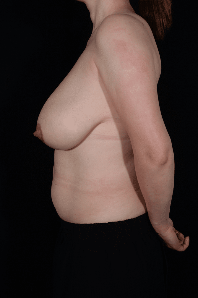 Before Image: Breast Reduction - left-side