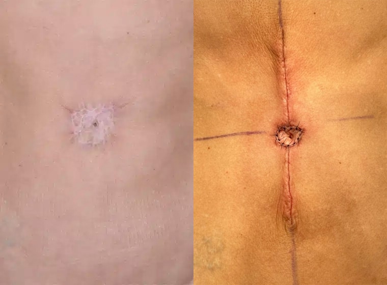 Postoperative image immediately post-procedure