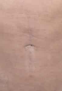 After Image: Umbilicoplasty