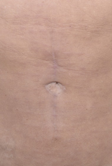 After Image: Umbilicoplasty - front