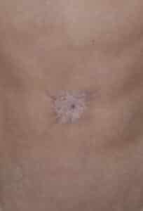 Before Image: Umbilicoplasty
