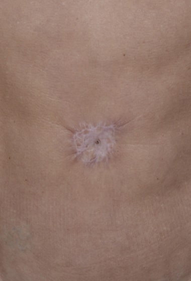 Before Image: Umbilicoplasty - front