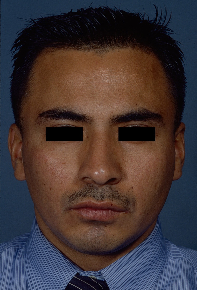 After Image: Rhinoplasty - front