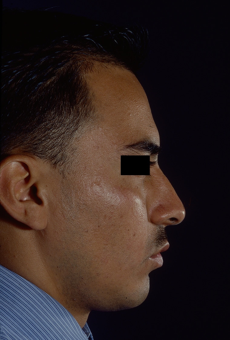 After Image: Rhinoplasty - right-side