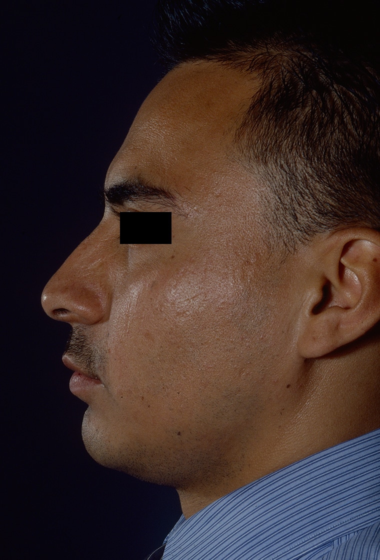 After Image: Rhinoplasty - left-side