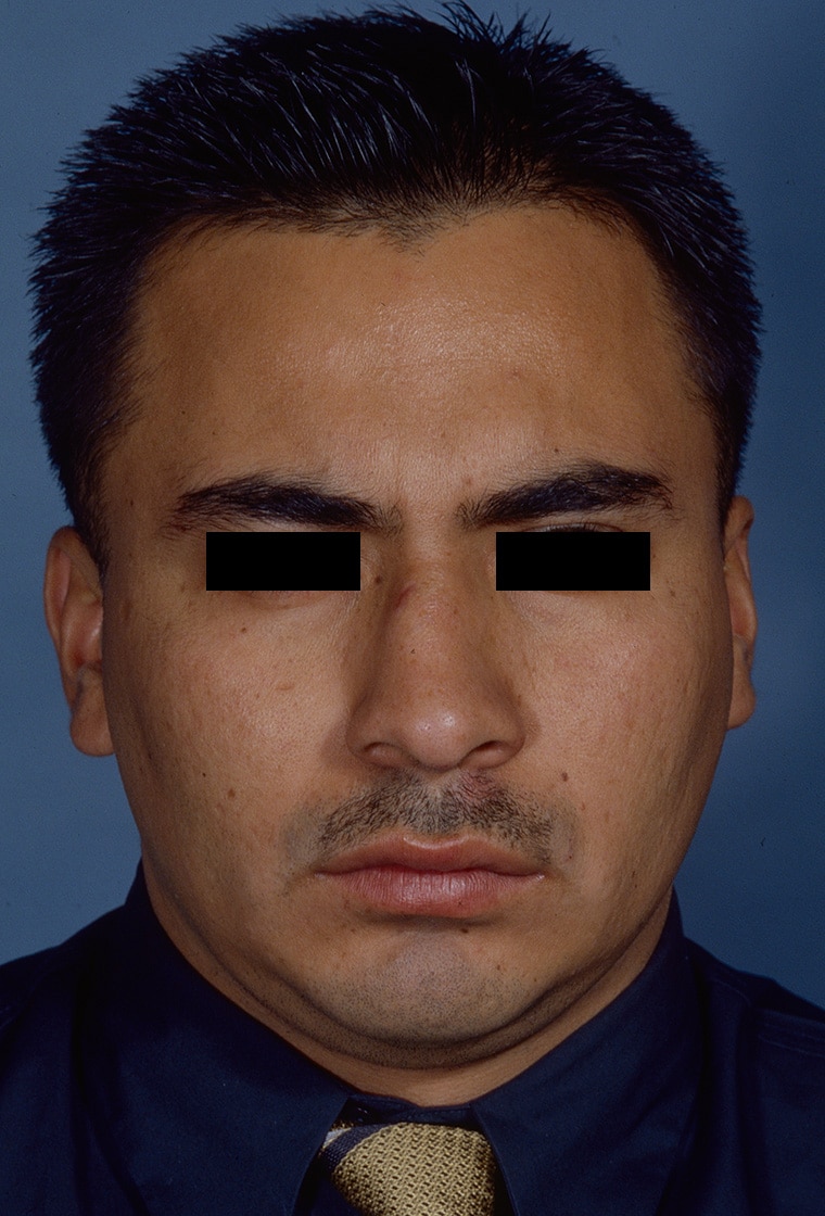 Before Image: Rhinoplasty - front