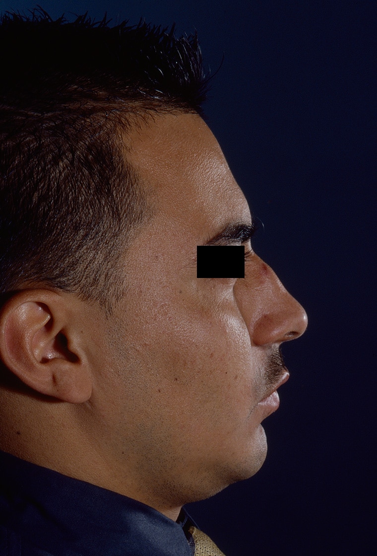 Before Image: Rhinoplasty - right-side