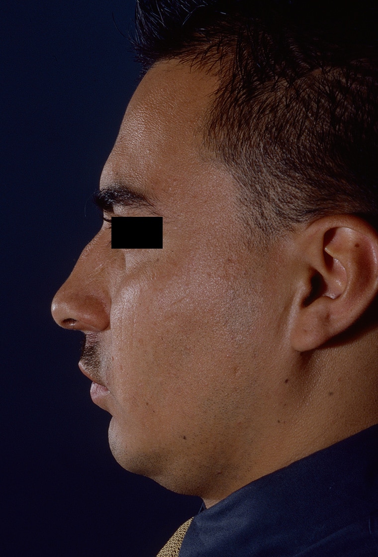 Before Image: Rhinoplasty - left-side