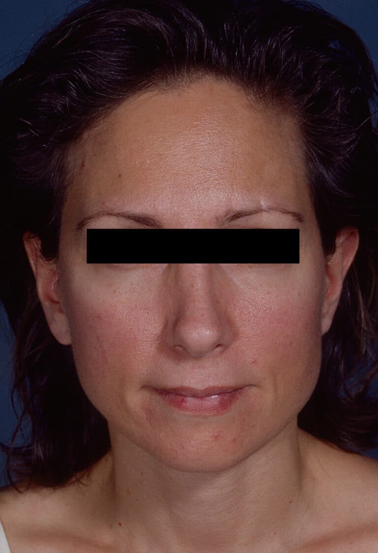 After Image: Facelift - front
