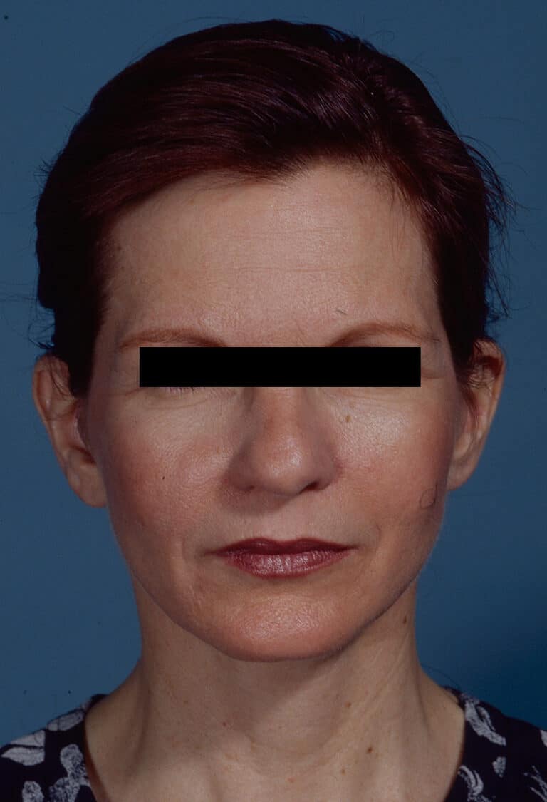 After Image: Facelift - front