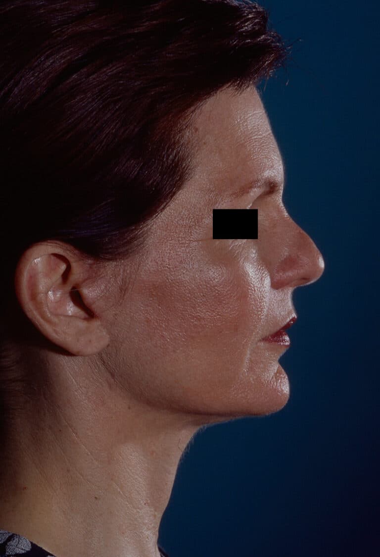 After Image: Facelift - right-side