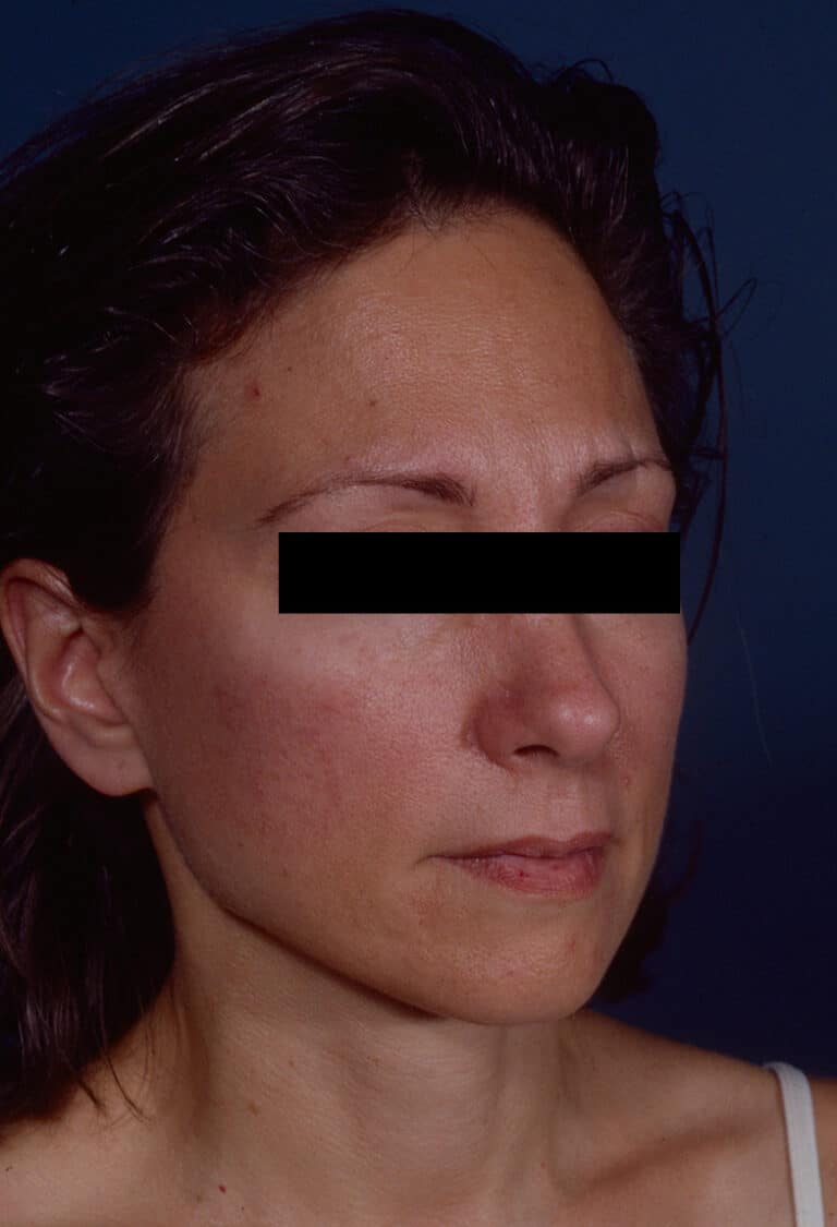 After Image: Facelift - right-front-oblique