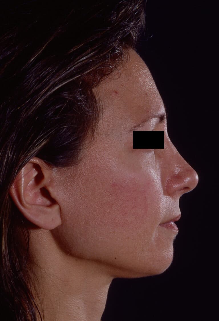 After Image: Facelift - right-side