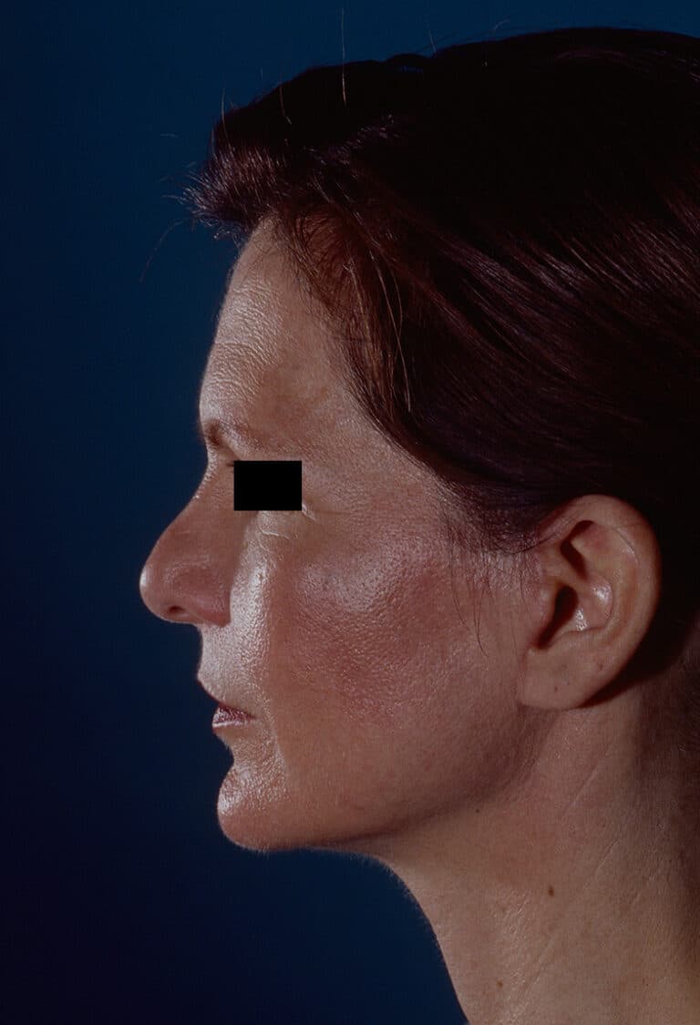 After Image: Facelift - left-side