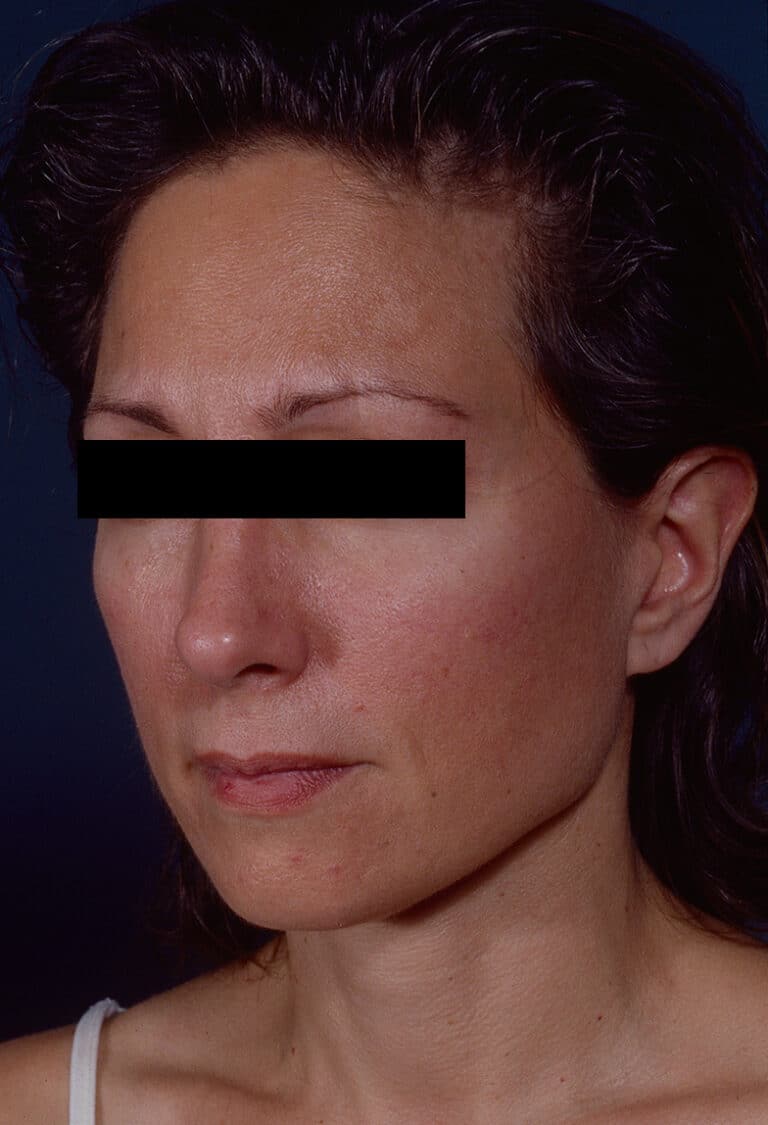 After Image: Facelift - left-front-oblique