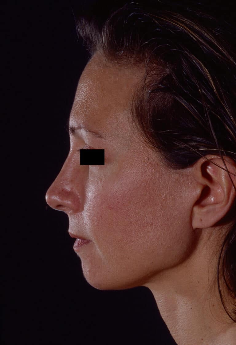 After Image: Facelift - left-side