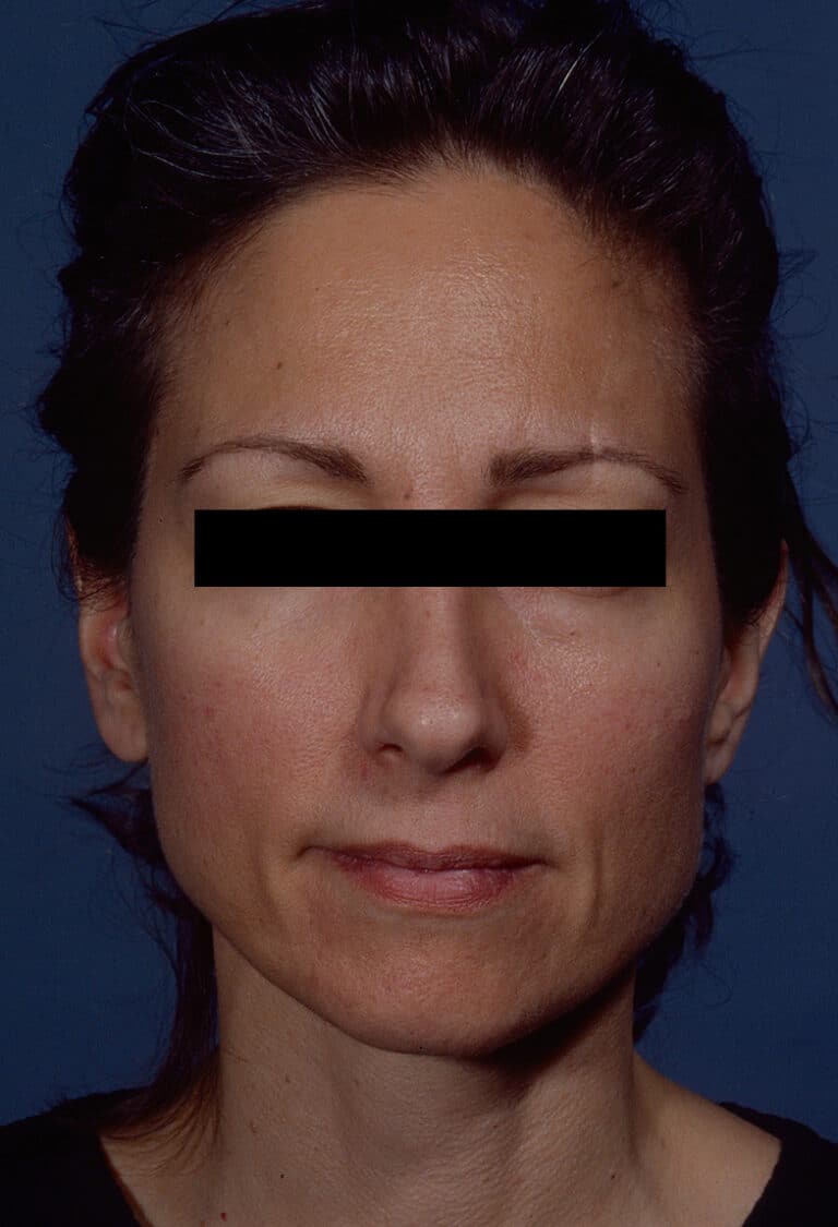 Before Image: Facelift - front