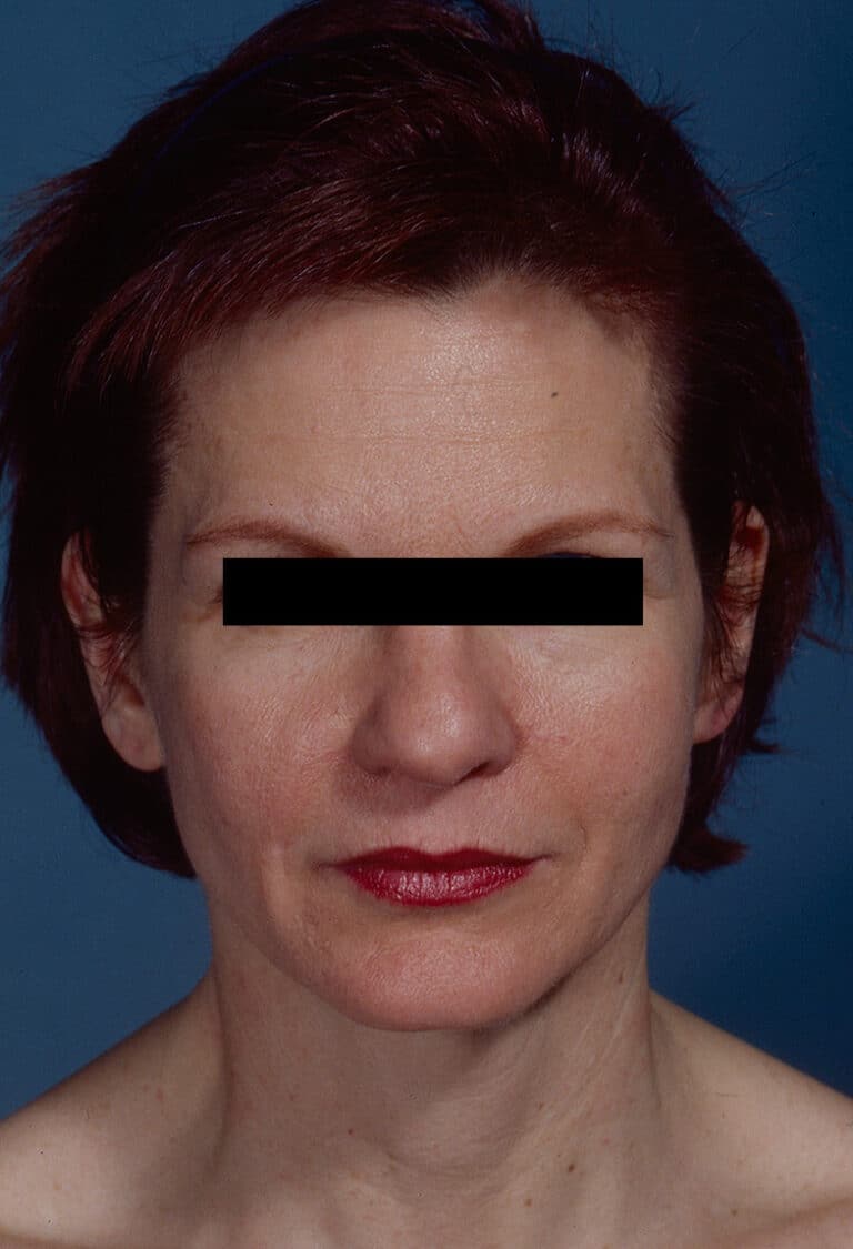 Before Image: Facelift - front