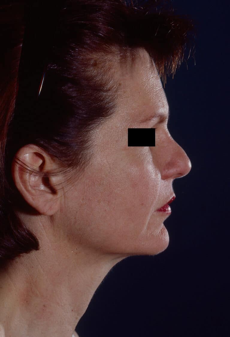 Before Image: Facelift - right-side