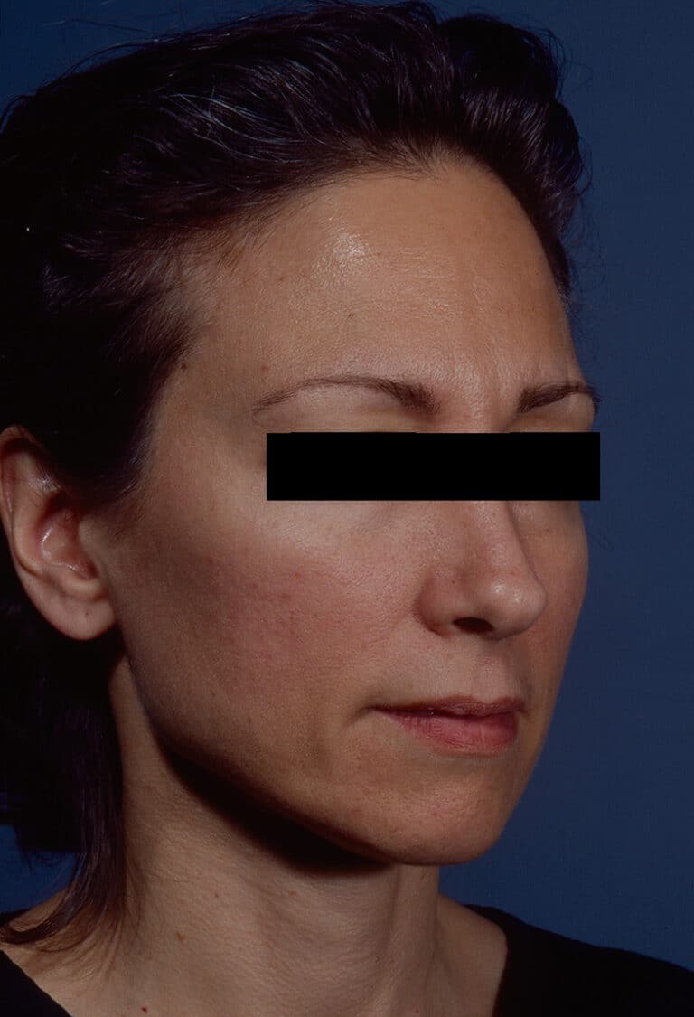 Before Image: Facelift - right-front-oblique