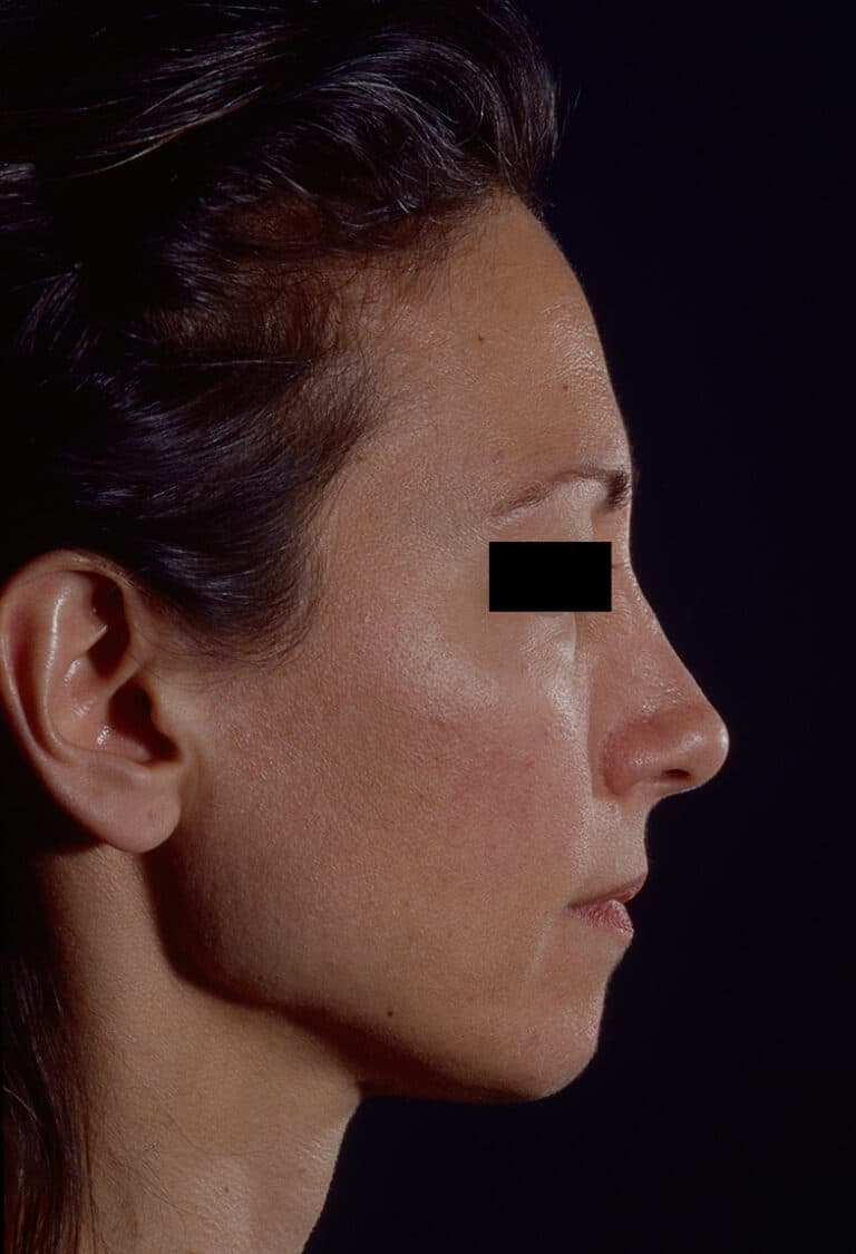 Before Image: Facelift - right-side