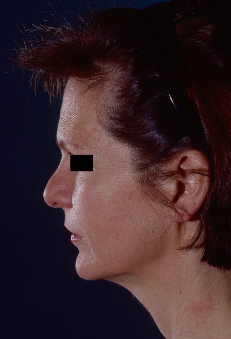 Before Image: Facelift - left-side