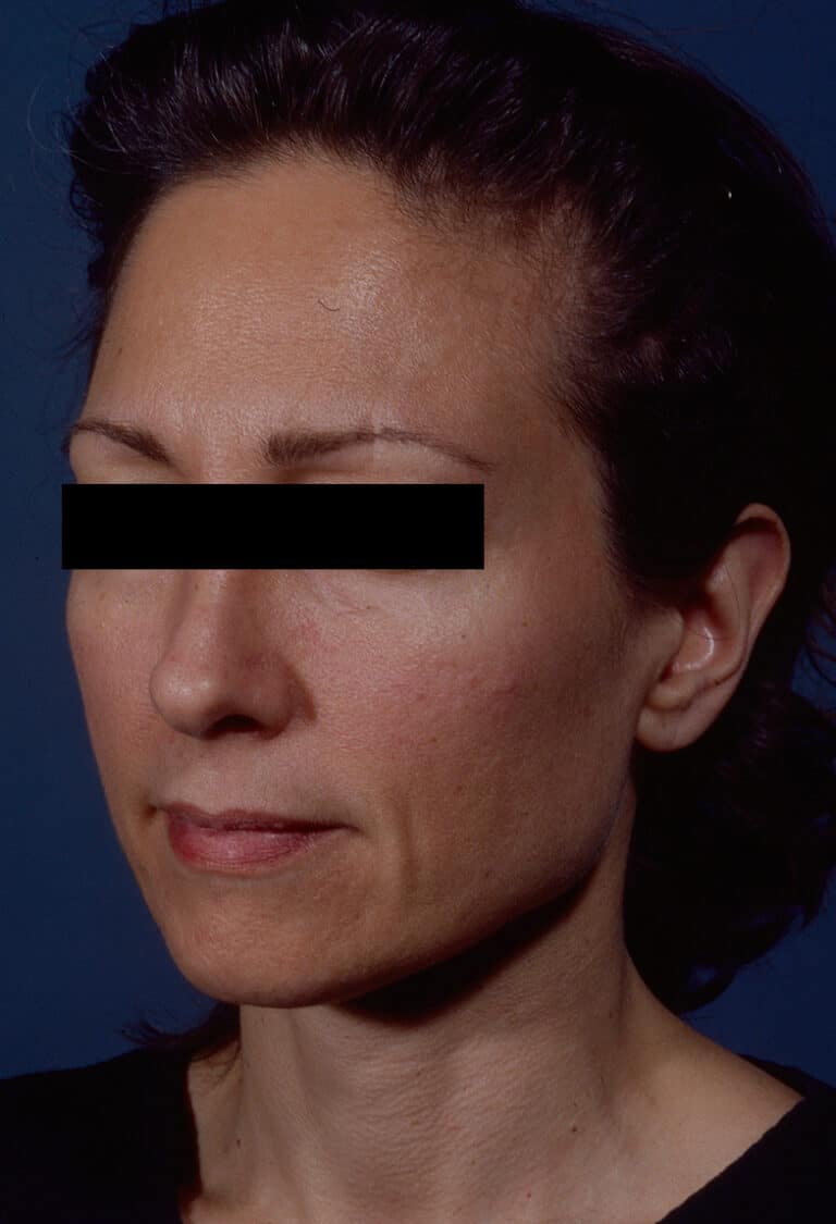 Before Image: Facelift - left-front-oblique