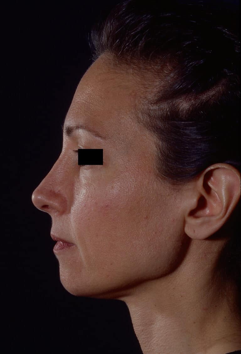 Before Image: Facelift - left-side