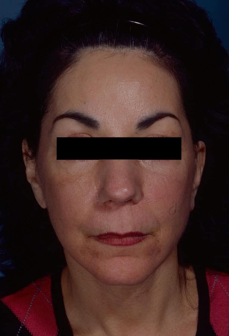 After Image: Facelift - front