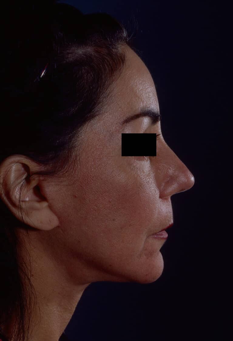 After Image: Facelift - right-side