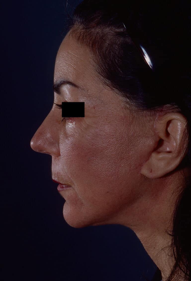 After Image: Facelift - left-side