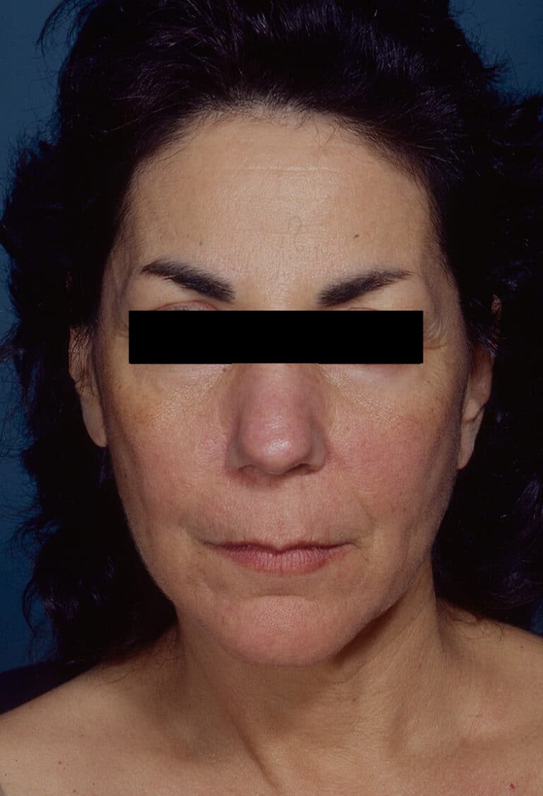 Before Image: Facelift - front