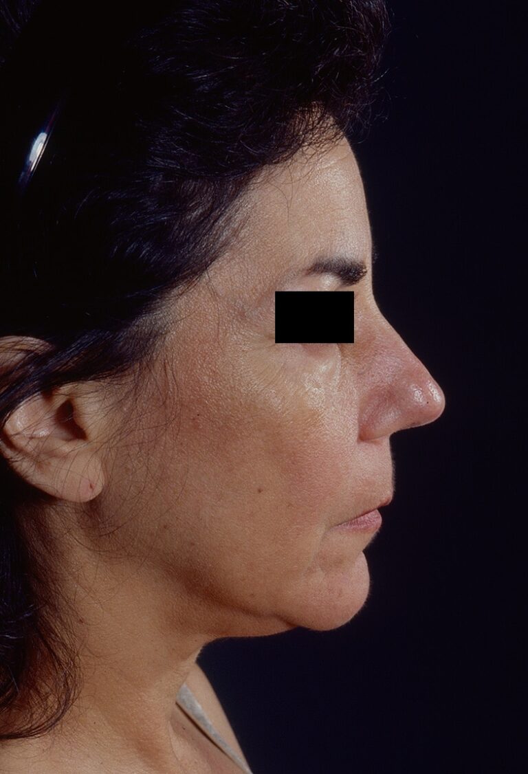 Before Image: Facelift - right-side
