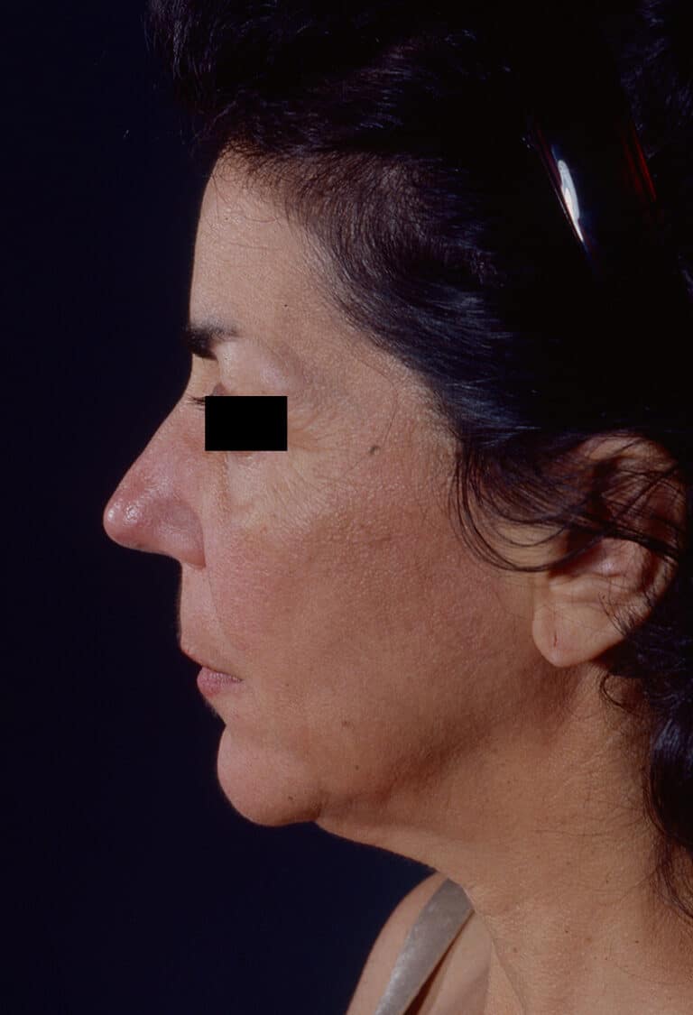 Before Image: Facelift - left-side