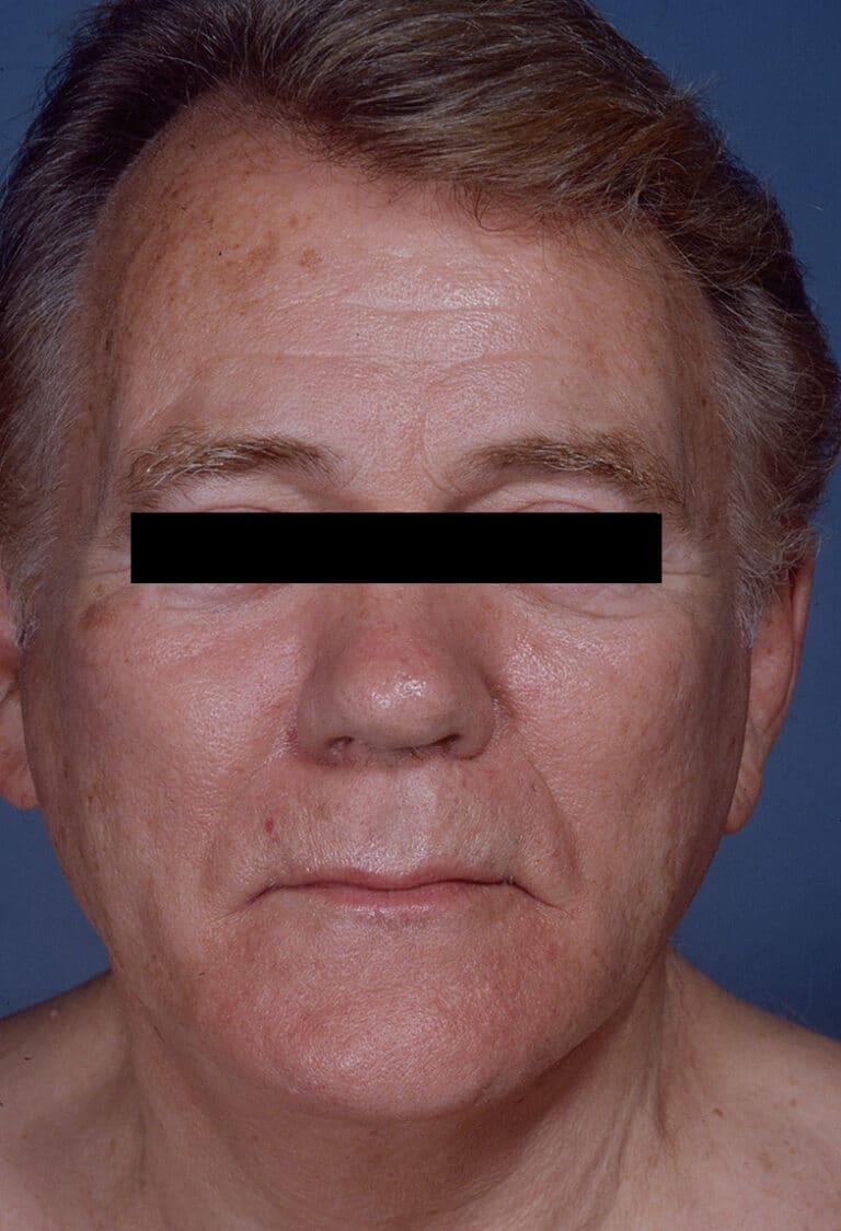 After Image: Facelift - front