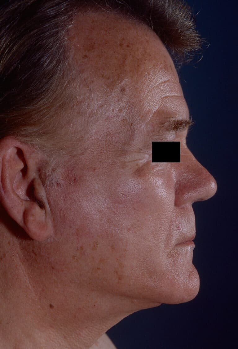 After Image: Facelift - right-side