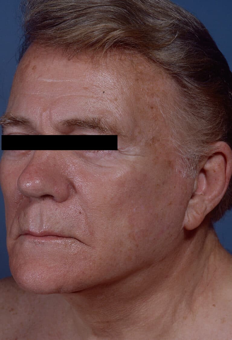 After Image: Facelift - left-front-oblique