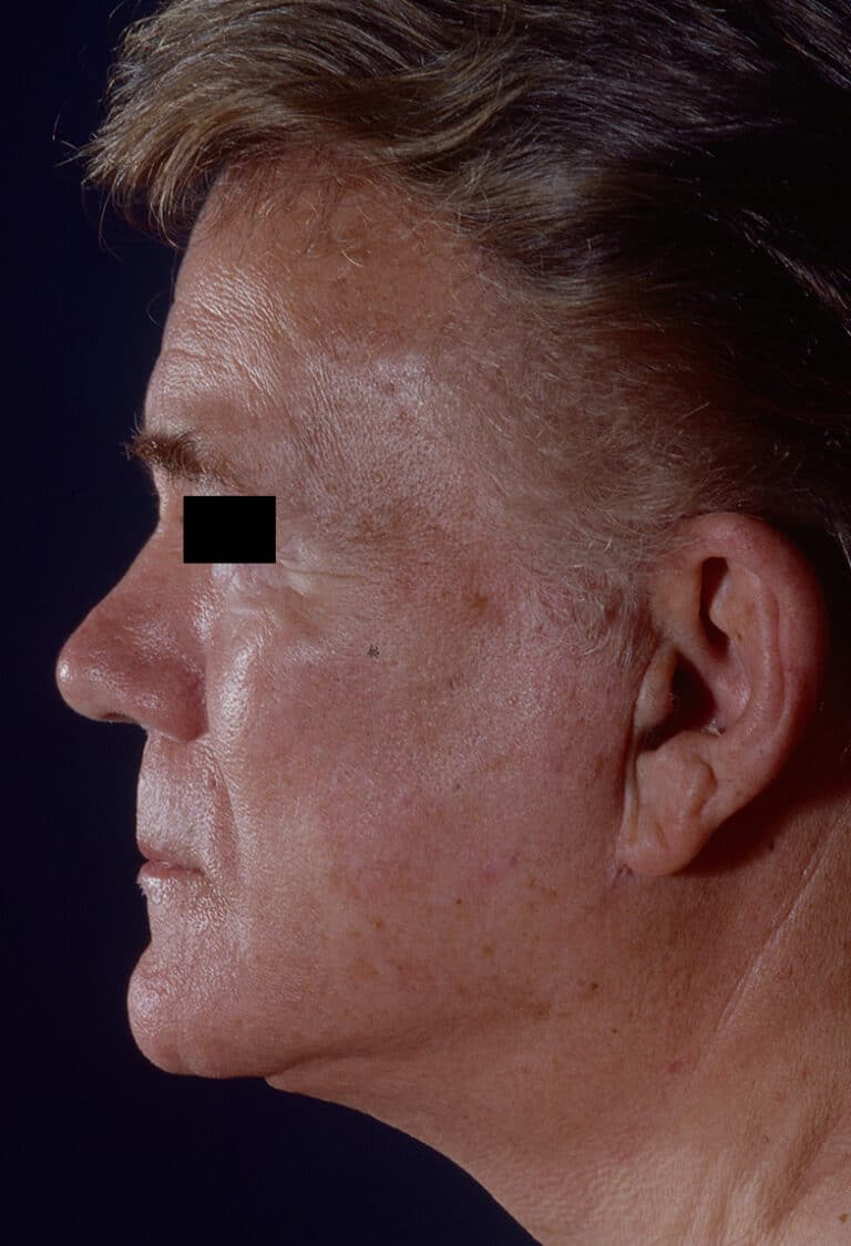 After Image: Facelift - left-side