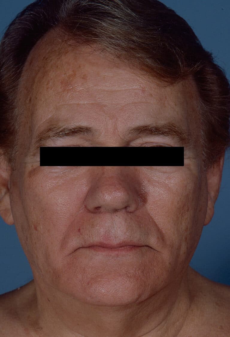 Before Image: Facelift - front