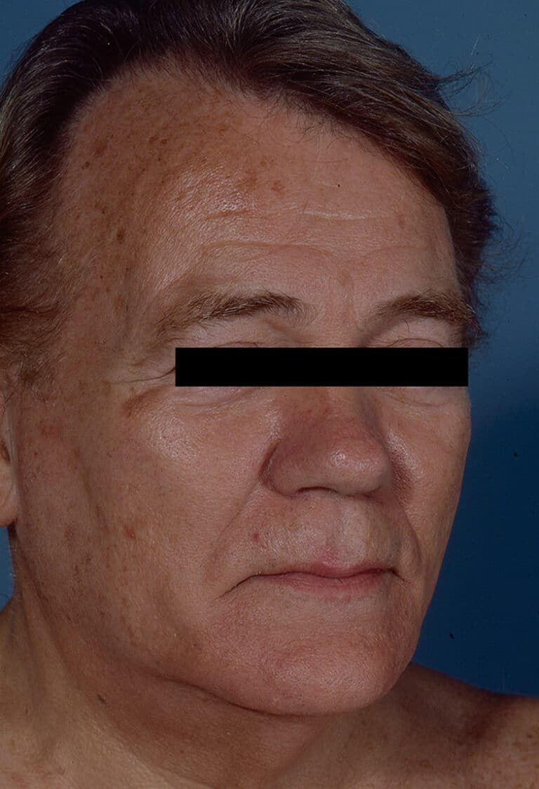 Before Image: Facelift - right-front-oblique