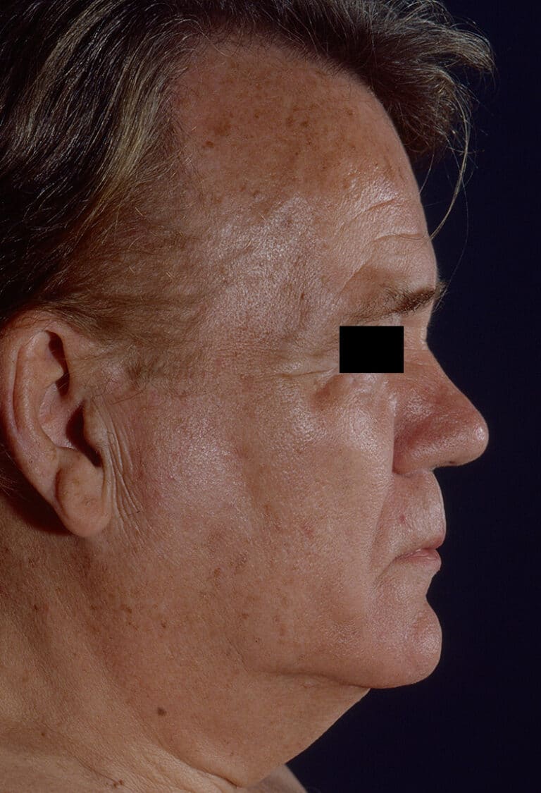 Before Image: Facelift - right-side