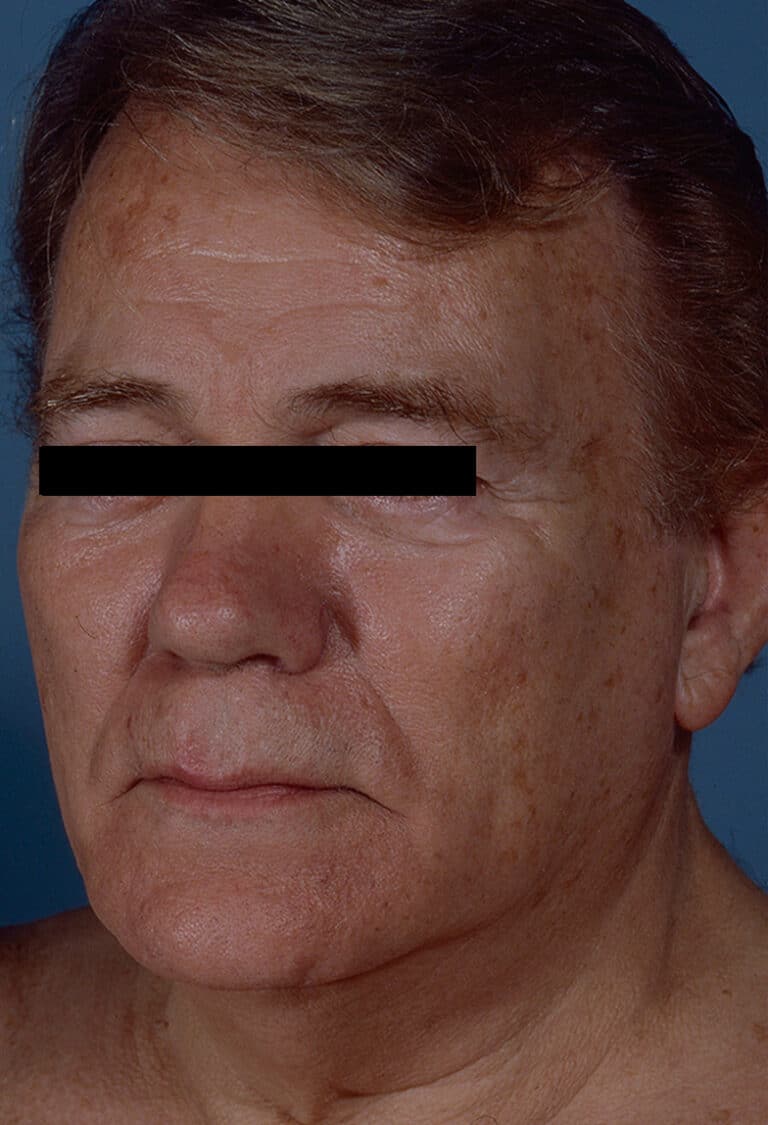 Before Image: Facelift - left-front-oblique