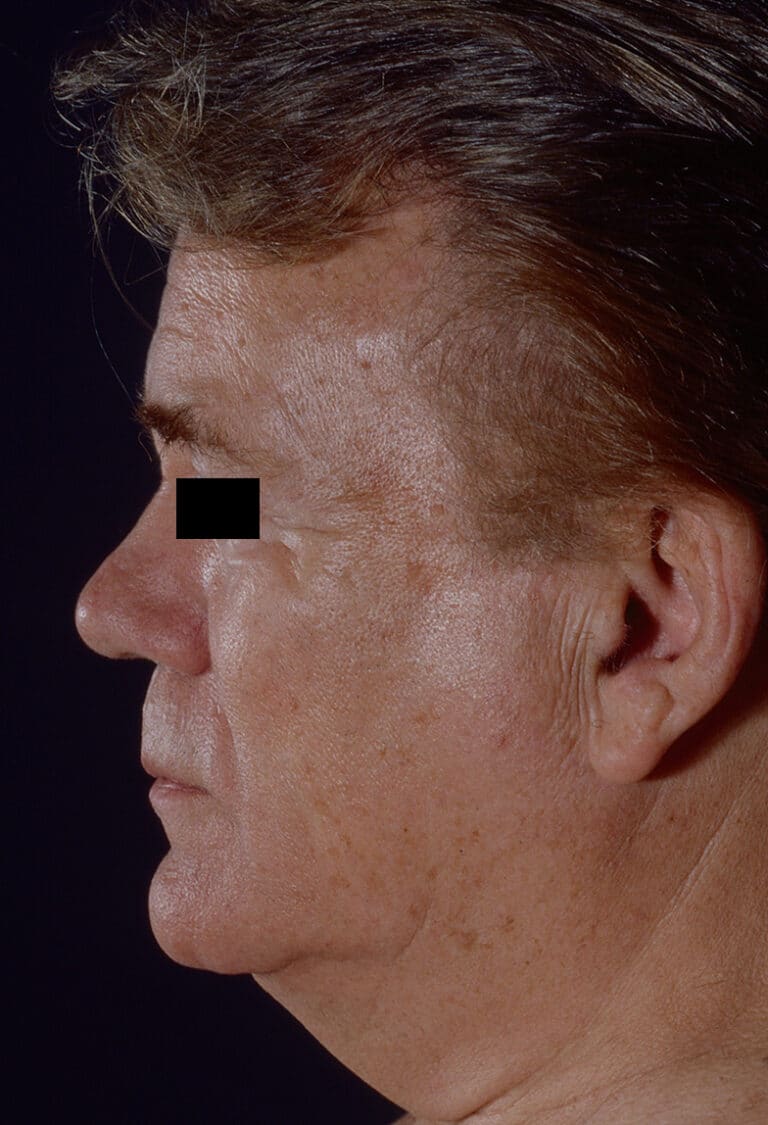 Before Image: Facelift - left-side