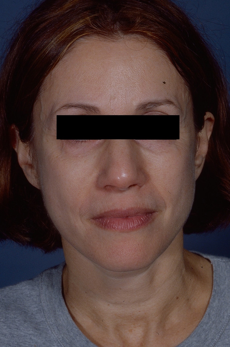 After Image: Facelift - front
