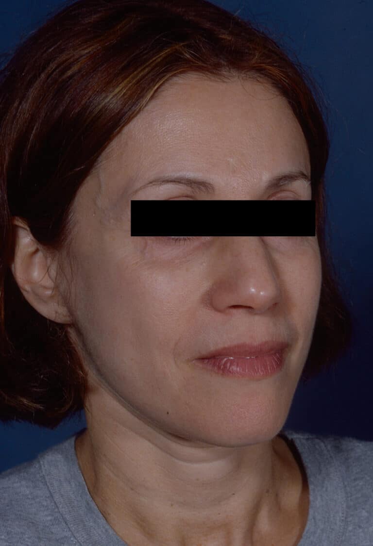 After Image: Facelift - right-front-oblique