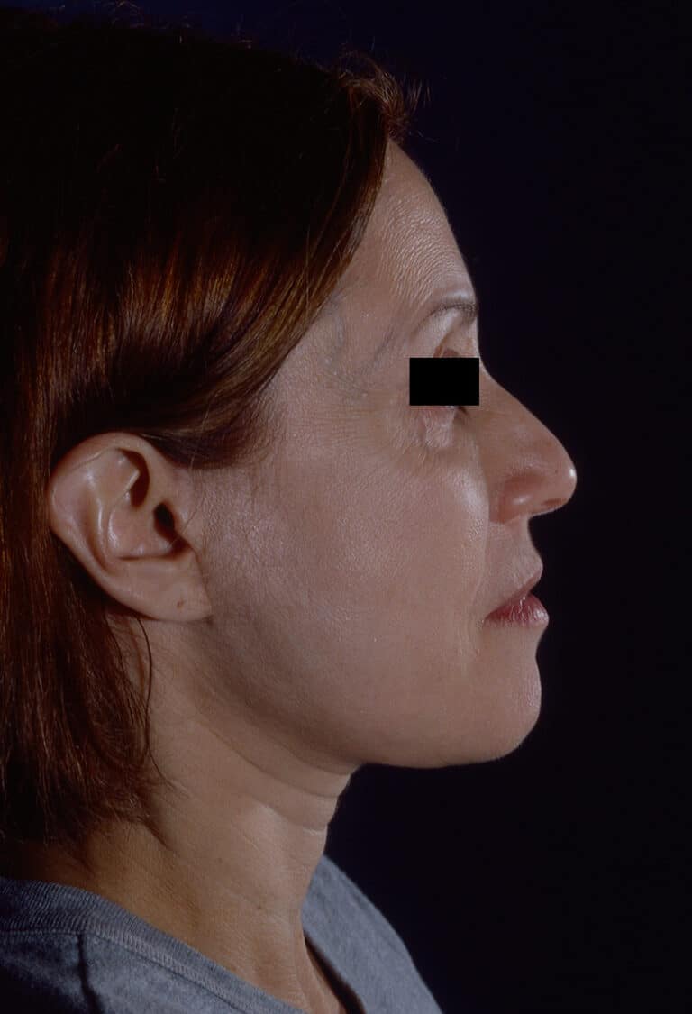 After Image: Facelift - right-side