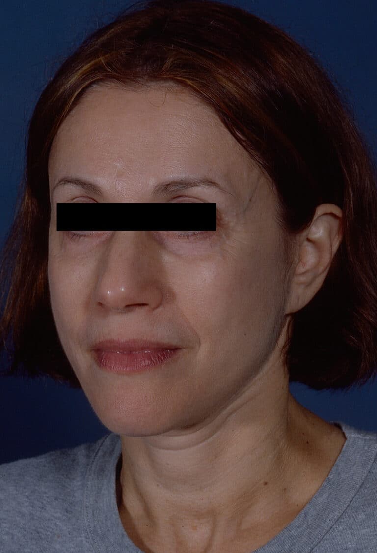 After Image: Facelift - left-front-oblique